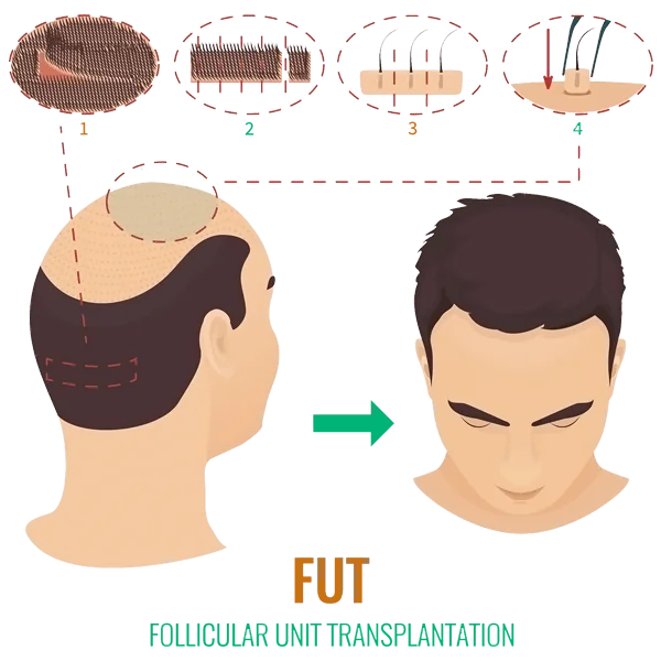 Follicular Unit Transplantation