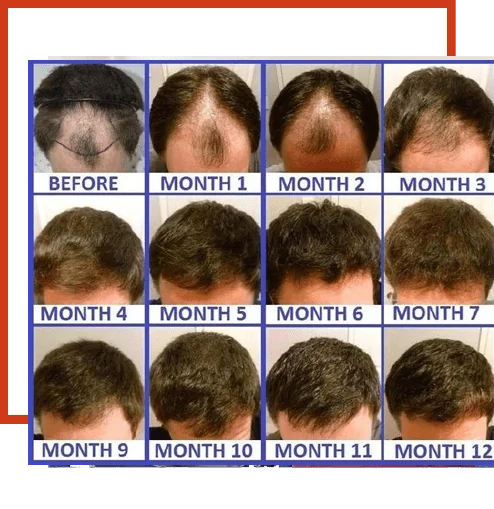 HAIR TRANSPLANT SURGERY IN TARN TARAN