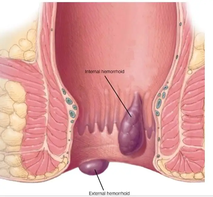 best Piles laser treatment in jalandhar