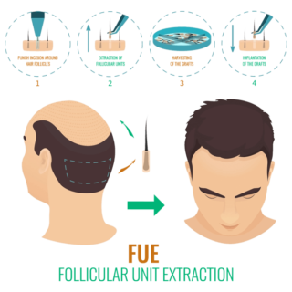 Hair Transplant Surgery