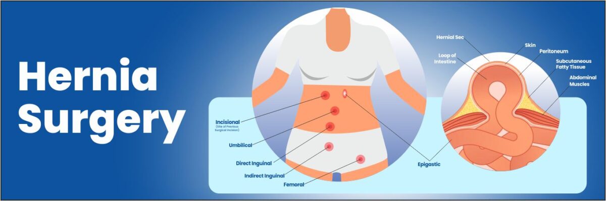 Hernia Surgery in batala