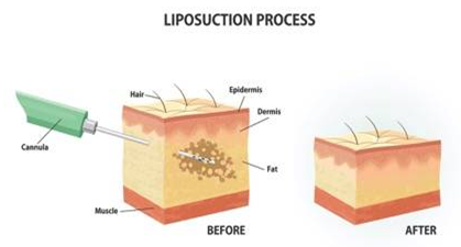 liposuction