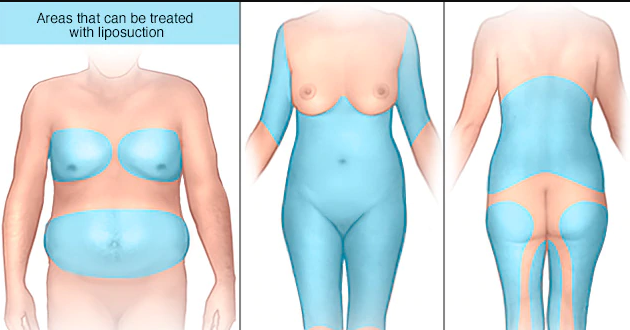 liposuction surgery in phagwara