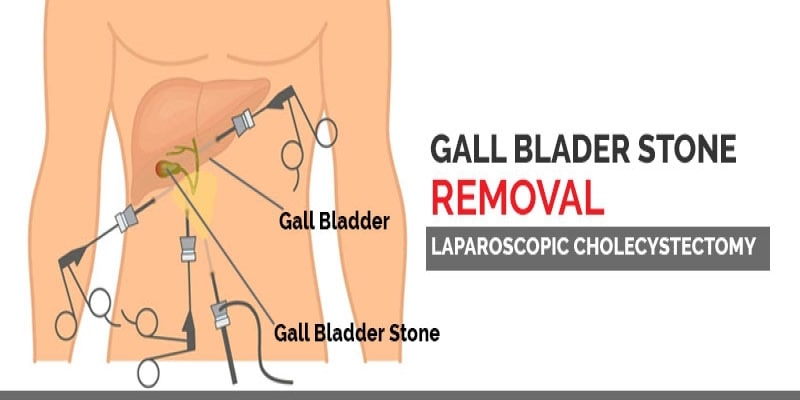 Gall Bladder Stone Removal Surgery In Ludhiana
