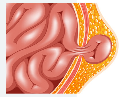 hernia surgery