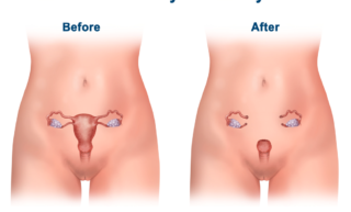 HYSTERECTOMY SURGERY IN Chandigarh 
