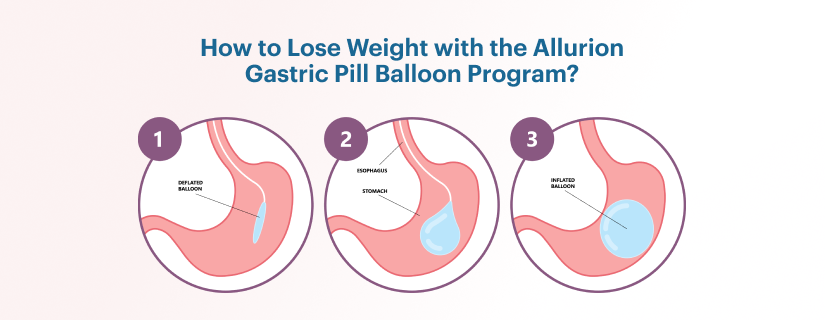 SWALLOWABLE GASTRIC BALLOON