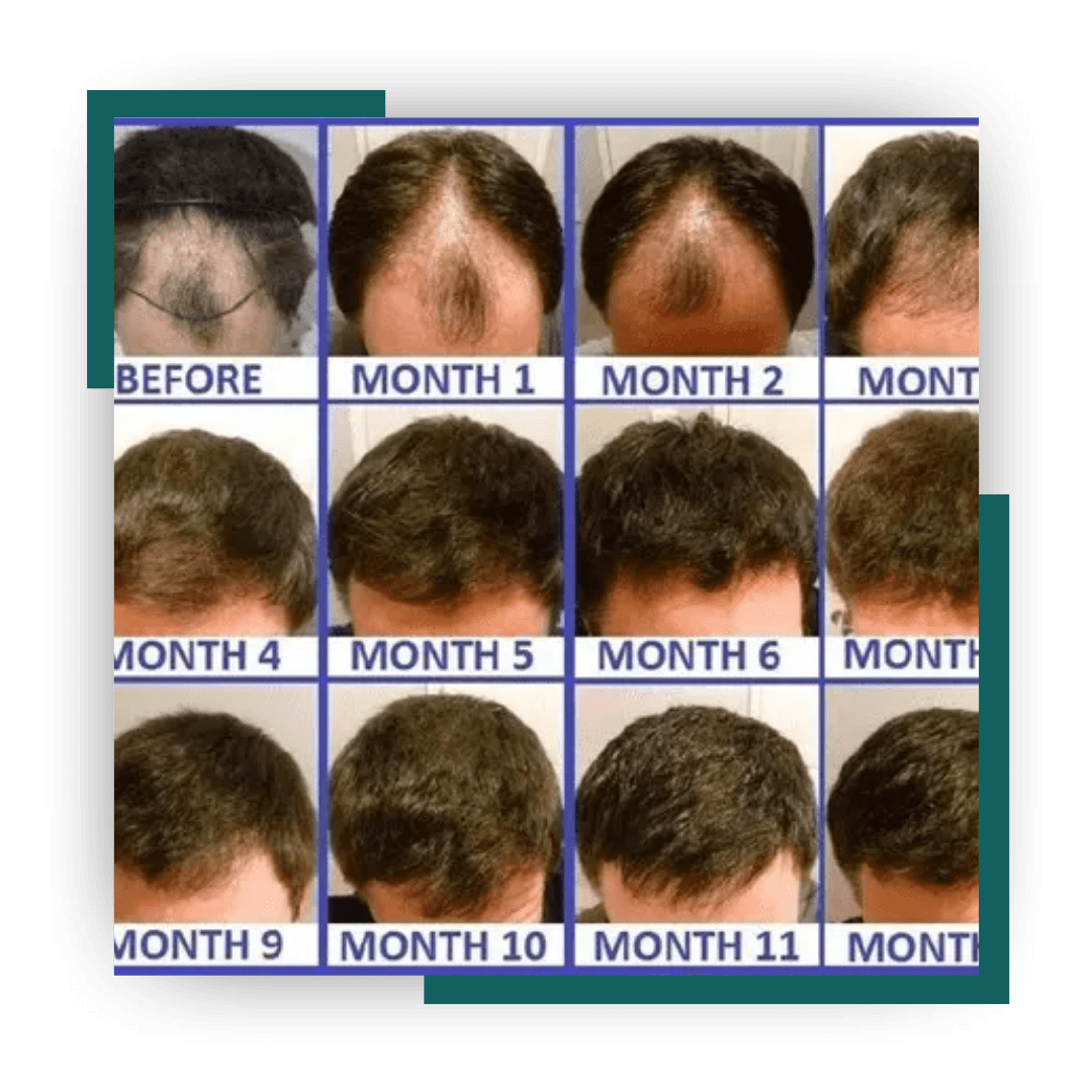 Hair Transplant Surgery in Jalandhar