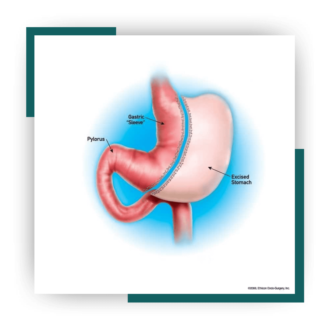 Bariatric Surgery