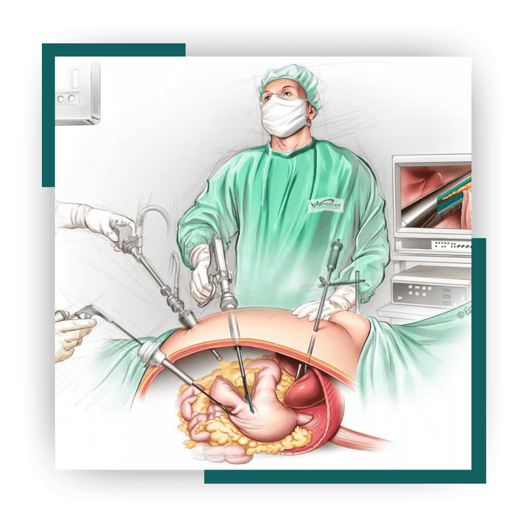 Sleeve Gastrectomy Surgery