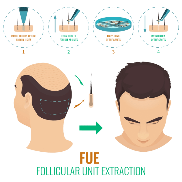 FUE Hair Transplant :