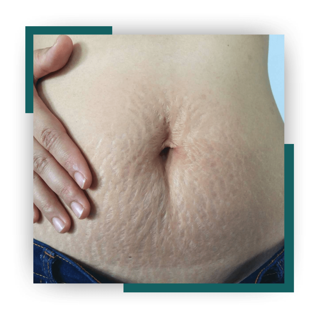 PREGNANCY STRETCH MARKS REMOVAL TREATMENT IN INDIA